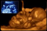 fetal_ultrasound_20_weeks_s8.jpg