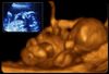 fetal_ultrasound_20_weeks_s8.jpg