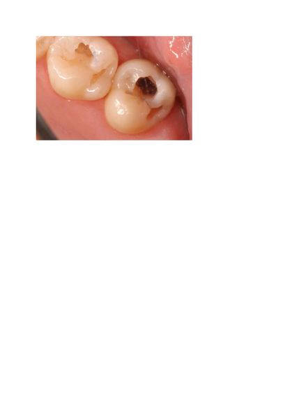 tooth with caries jpeg.jpg