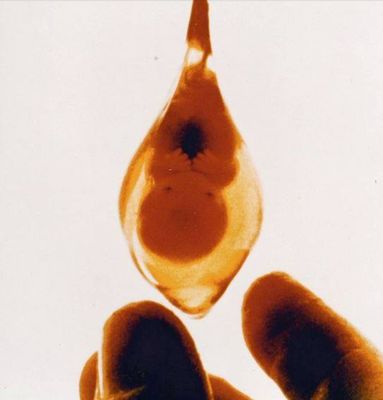 DES Ectopic Baby.jpg